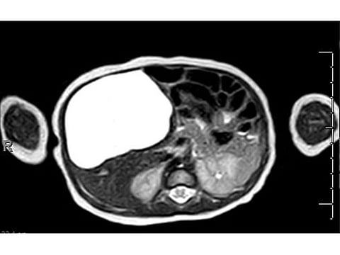 A scan showing the cyst in white 