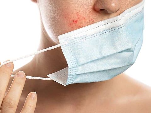 Wearing masks is an essential weapon against COVID-19 but it has uncovered a new problem which is mask related acne, also known as 'maskne.'