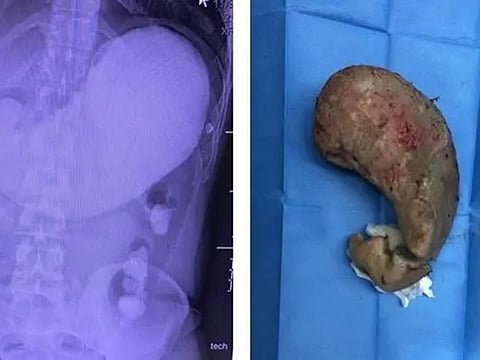  After a 3-hour operation, surgeons saved the man’s life and successfully extracted the cement he had eaten from his stomach.