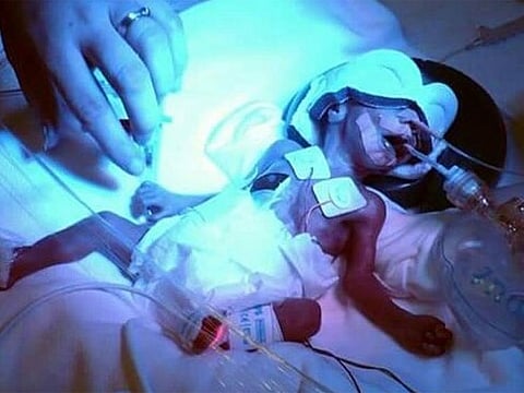 When Grace was born she weighed only 800 grams