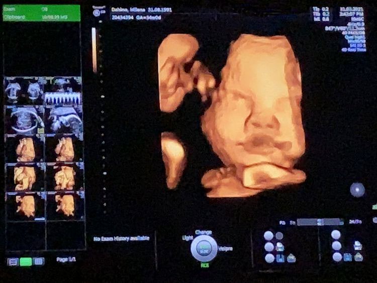 sonogram 1