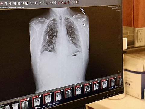 The researchers tested their robot while the laboratory model performed intermittent breath holding. 