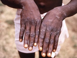 Monkeypox found in US and UK. What is it and should you be worried?