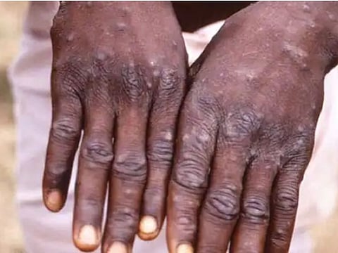 Monkeypox virus cases have sparked concerns in many European countries — Belgium, France, Germany, Italy, the Netherlands, Portugal, Spain, Sweden and the United Kingdom — even as cases have been reported from the United States, Canada and Australia too. 
