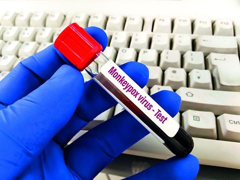 In a series of tweets from MoHaP, UAE residents have been provided a simple explanation of what Monkeypox is, its symptoms and what preventive measures need to be undertaken.