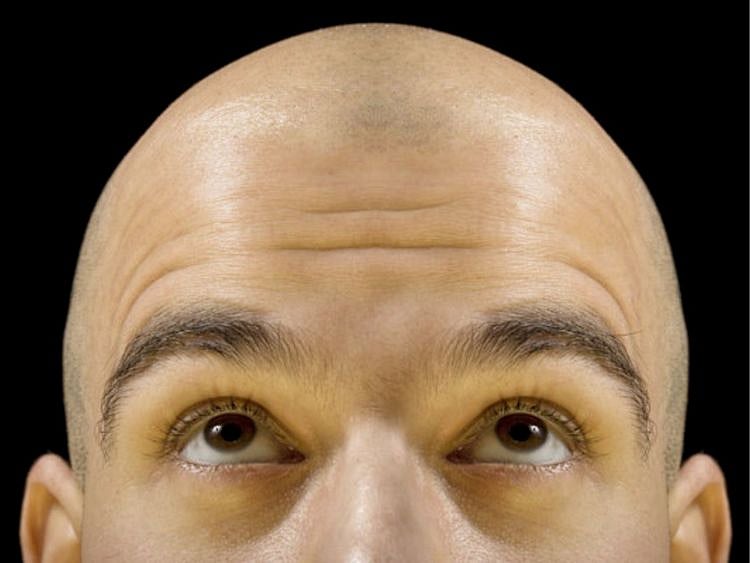 Alopecia Areata