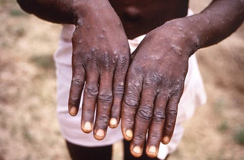  Monkeypox, a viral disease that causes flu-like symptoms and skin lesions, is endemic in parts of Africa, but this year there has been an increase in cases both on the continent and in the rest of the world.