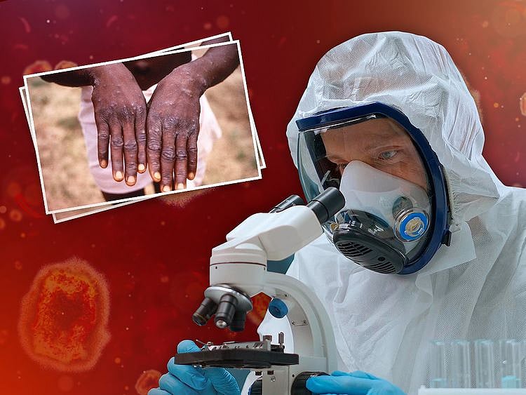 SPECIAL REPORT monkeypox