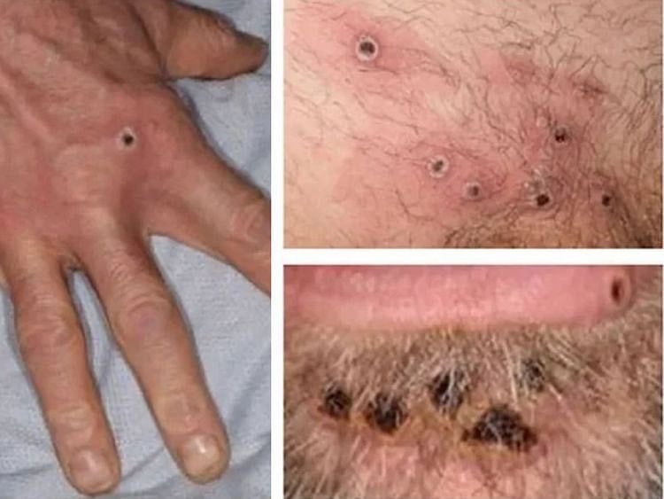 monkeypox rash lessions collage of monkeypox rash lesions at an undisclosed date and location. 