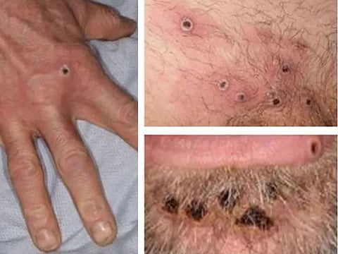 A handout photo taken on Wednesday, June 22, 2022, made available by the UK Health Security Agency shows a collage of monkeypox rash lesions at an undisclosed date and location. 