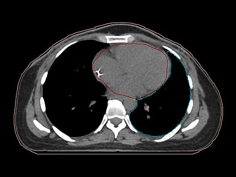 Free breathing (heart is in direct contact with chest wall)