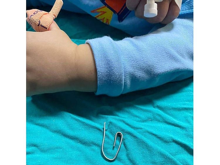  One of the clips removed from the baby.