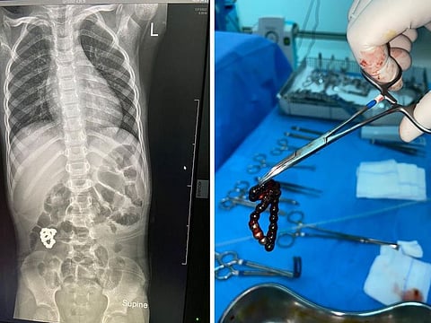  Combo image shows bracelet before and after removal. 