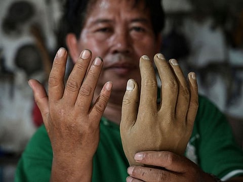 Former leprosy patient Ali Saga displaying a prosthetic hand (R) as he compares it to his own hand inside his workshop in Tangerang.