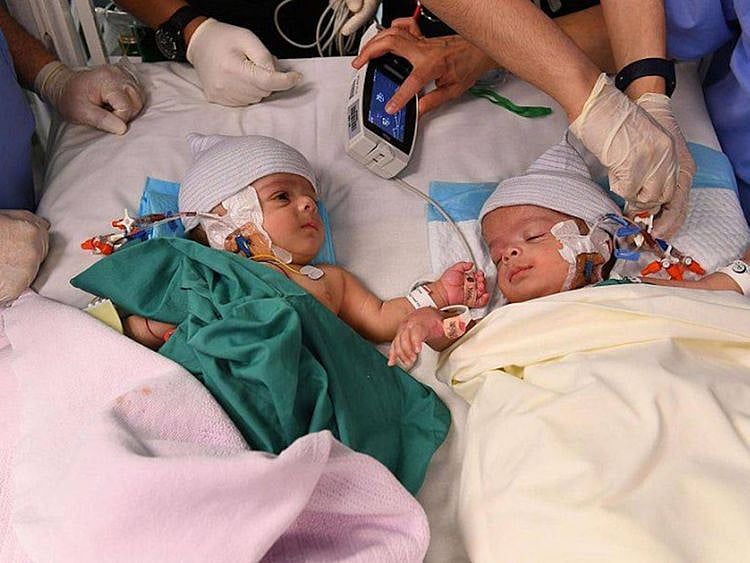 The Yemeni twins Salman and Abdullah.  Below: A link to a video aired by Saudi TV Al Ekhbariya shows the twins' father trying to kiss the head of Dr Al Rabeeah in a sign of appreciation following the successful separation procedure.