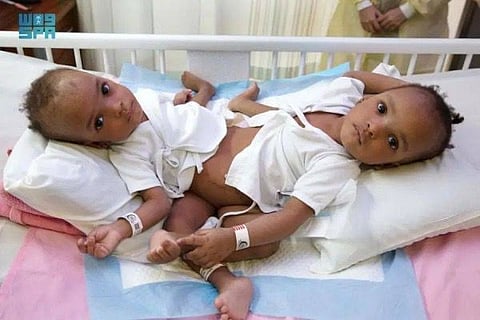 Hassana and Hasina, from Kaduna, were born on January 12, 2022.