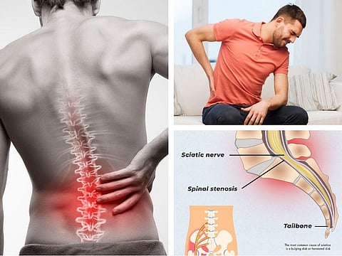 Sciatica refers to the pain that originates in the lower back, goes into the buttock and travels down the leg.
