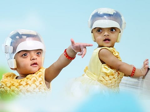 One-year-old twins Jumana and Jennah have come a long way after being operated upon to correct skull deformities which they were born with.