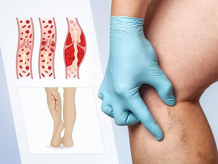 DVT