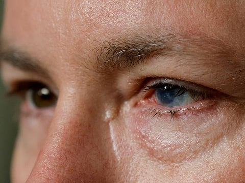 Phil Durst, who has undergone an experimental stem cell procedure with his eyes, sits for a portrait in Homewood, Alabama. His left eye bore the brunt of a 2017 work accident, which stole his vision, left him unable to tolerate light and triggered four to five cluster headaches a day. 