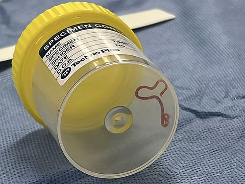 This undated photo supplied by Canberra Health Services, shows a parasite in a specimen jar at a Canberra hospital in Australia. A neurosurgeon investigating a patient's mystery neurological symptoms in an Australian hospital has been surprised to pluck a 3-inch wriggling worm from her brain. 