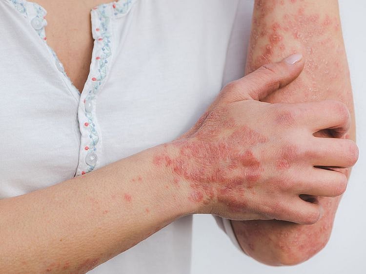 STOCK skin disease psoriasis 