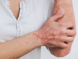 Chronic skin diseases can raise heart disease risk: Study