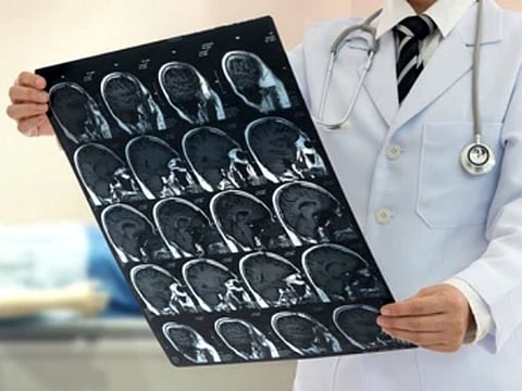 A stroke occurs when a blood vessel responsible for supplying oxygen and blood to the brain is either blocked or interrupted, leading to a deficiency in blood and oxygen, which can cause brain cells to perish.
