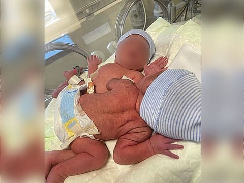 UAE: Mom hopes for surgery for conjoined twins