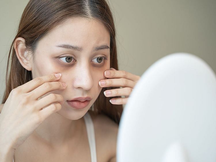 dark circles