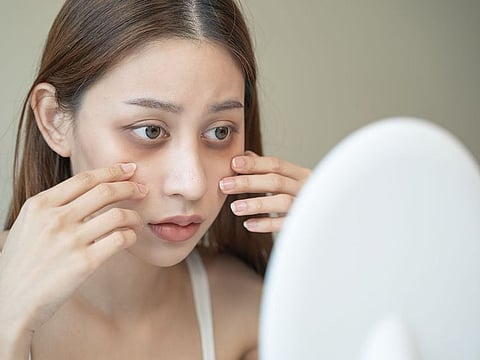 Not all dark circles are the same; they can be triggered by different causes, according to our expert.