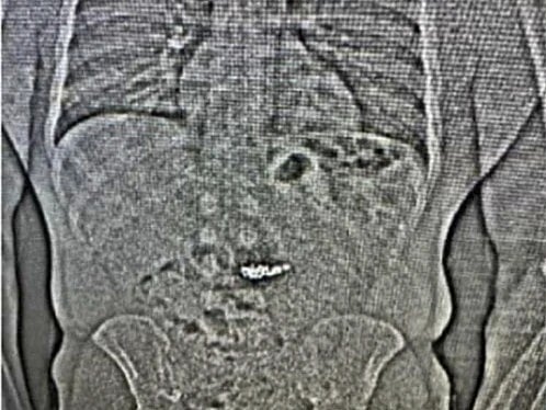 Thief swallowed $760,000 Tiffany diamond earrings, jury finds him guilty