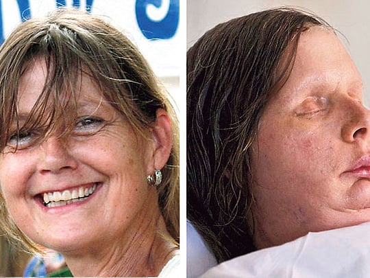 Face transplant patients go public