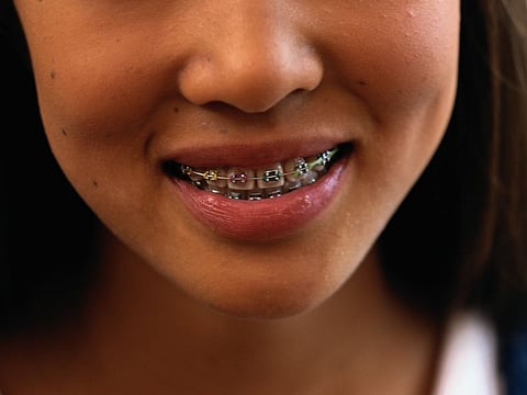 oral braces