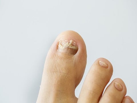toenail fungus