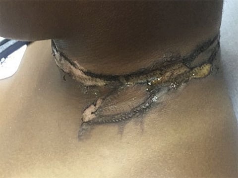 Neck burn caused by phone charger