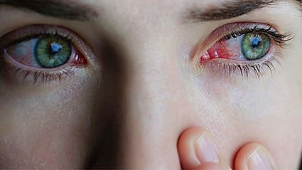 a person with a redness in the eye