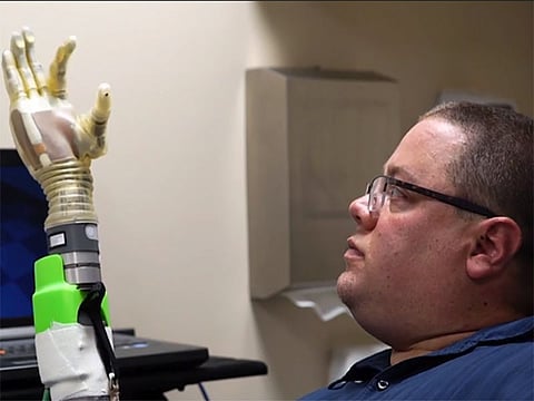 prosthetic hand