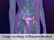 No Overall Survival Benefit Tied to Bilateral Oophorectomy