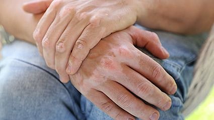 ¿Un tratamiento prometedor para el vitiligo?
