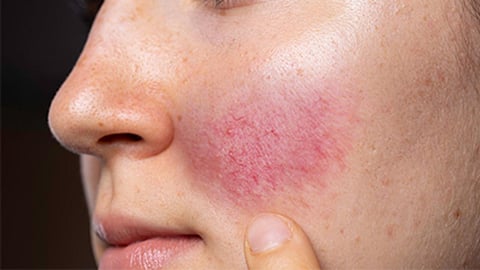 Is Your Mask Causing Your Face to Break Out?