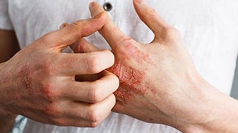 eczema