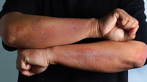 Según un nuevo estudio, los pacientes con dermatitis atópica presentan un alto riesgo de cáncer de piel
