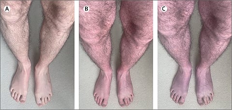 onetimeuse blue legs syndrome