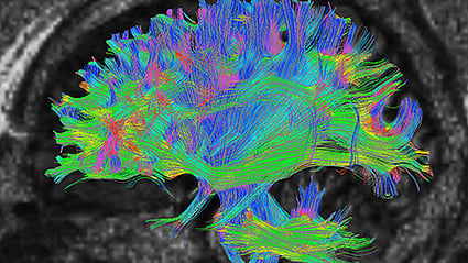 Autism Spectrum Disorder