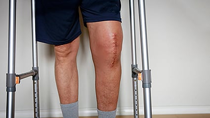 After Knee Replacement Operation