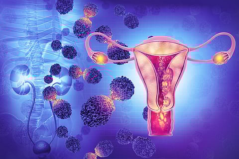uterine endometrial cancer