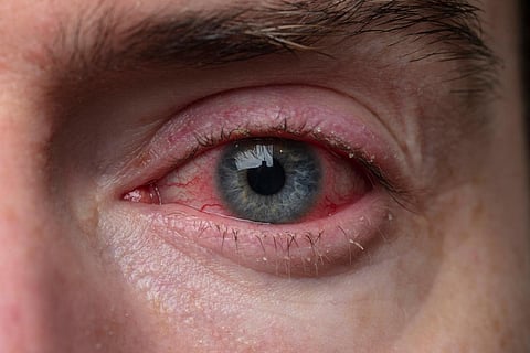 Close up of a severe bloodshot eye. Blepharitis, Conjunctivitis condition
