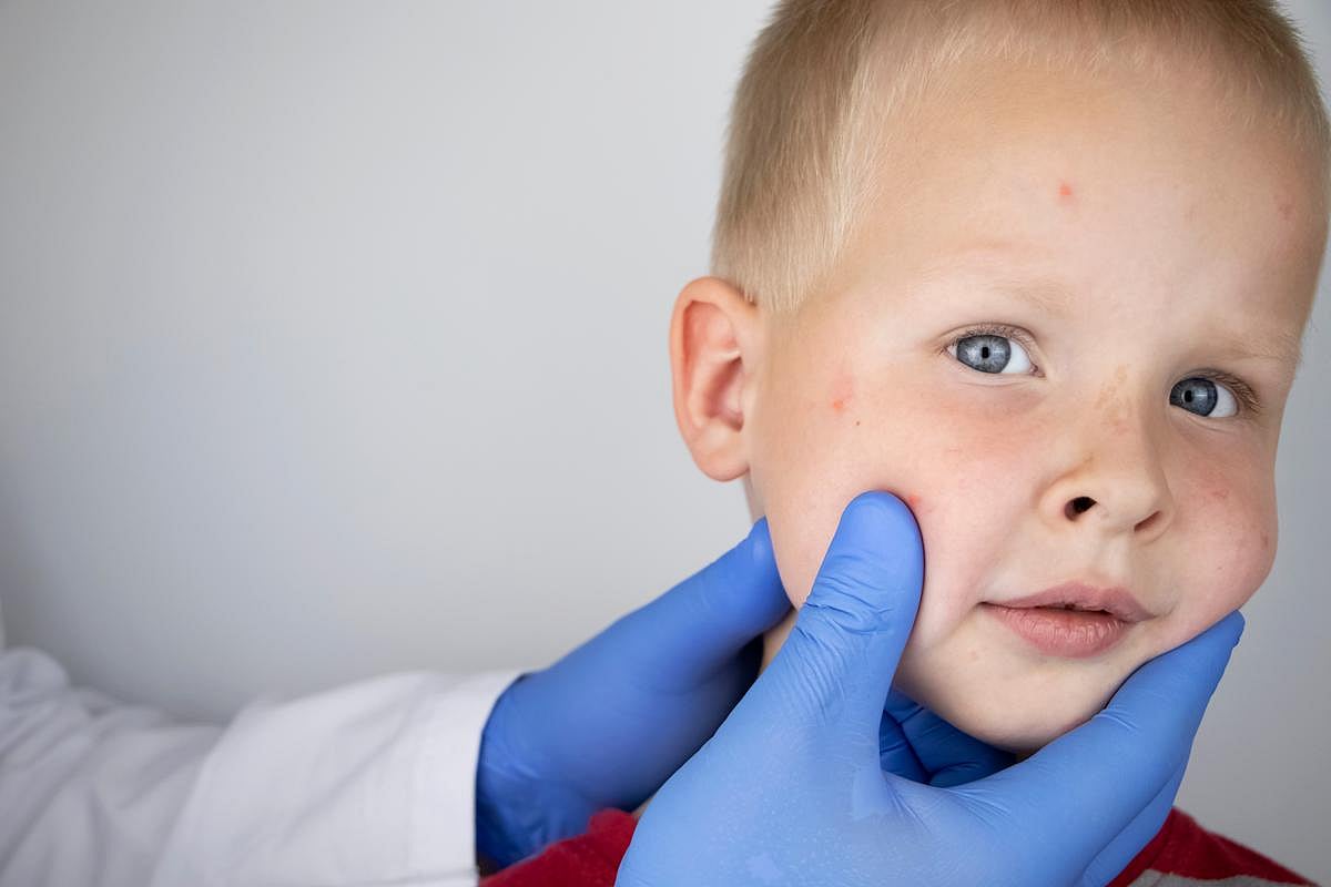 ACAAI: Eczema Onset, Severity Can Effect Child's Ability to Outgrow Food Allergy