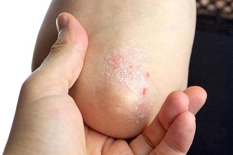 psoriasis elbows